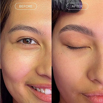 Wavefront Guided LASIK