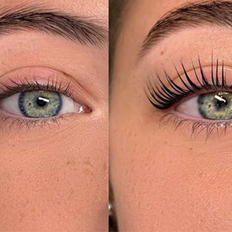 Topography Guided LASIK